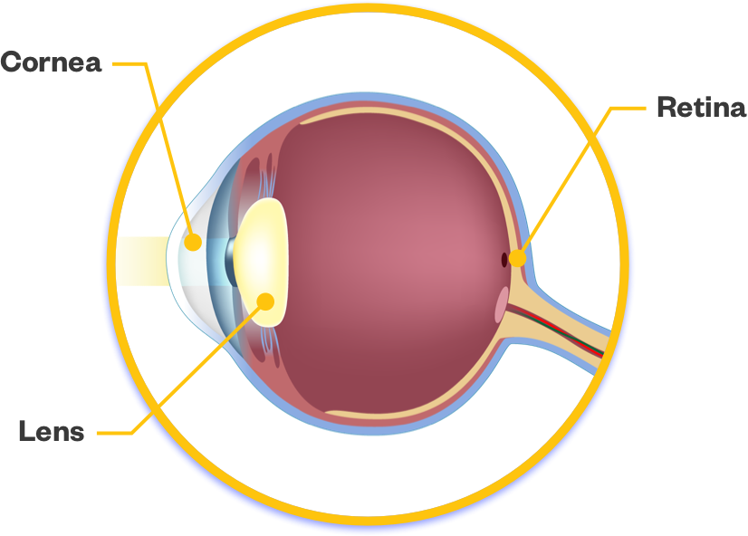 Eye with cataract